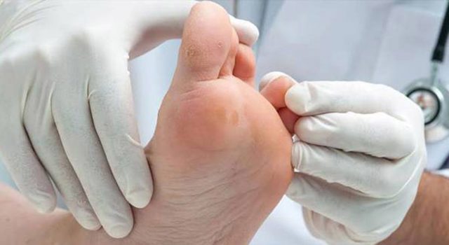 پیشگیری و درمان مشکلات پای دیابتی