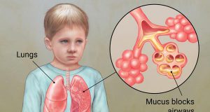 لزوم حمایت دولت از بیماران CF