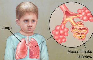 لزوم حمایت دولت از بیماران CF