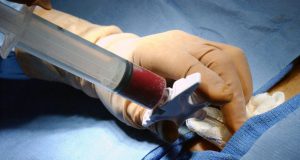 پیوند مغز استخوان در بیماران تالاسمی چیست؟