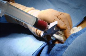 پیوند مغز استخوان در بیماران تالاسمی چیست؟