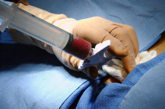 پیوند مغز استخوان در بیماران تالاسمی چیست؟