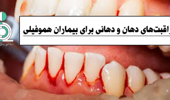 مراقبتهای دهان و دندانی برای بیماران هموفیلی