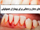 مراقبتهای دهان و دندانی برای بیماران هموفیلی